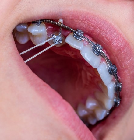 Брекеты для взрослых: когда стоит ставить и сколько носить