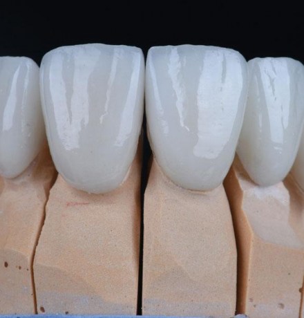 Срок службы виниров: как продлить красоту вашей улыбки