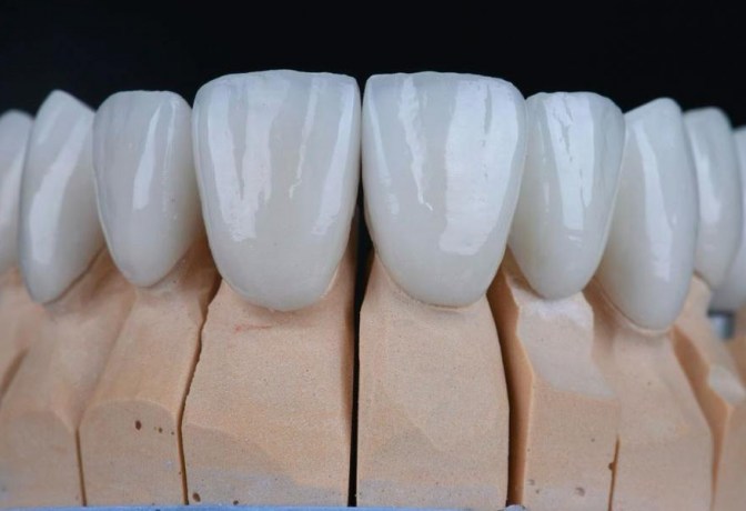Виниры для зубов: что это такое, плюсы и минусы