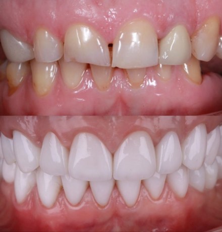 Лучшие зубные коронки: какие выбрать?