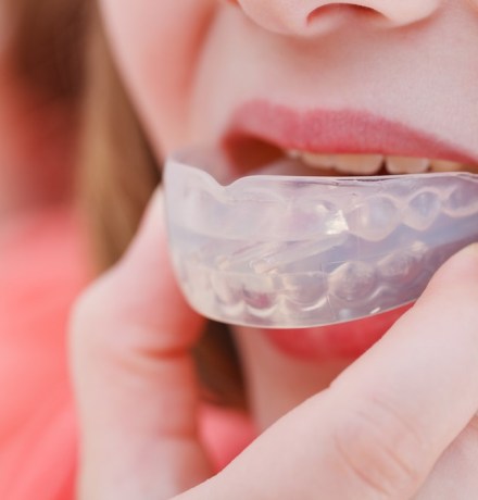 Ортодонтические капы для лечения ВНЧС и расслабления челюсти