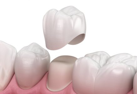 Протезирование зубов установкой коронок: медицинские показания