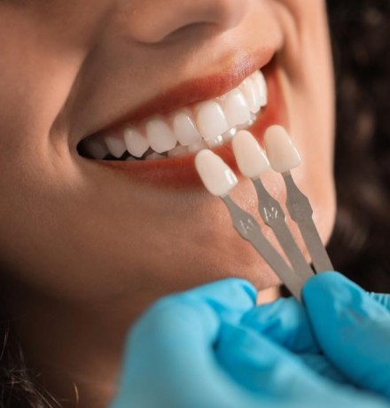 Ультраниры: что это такое и чем отличаются от виниров и люминиров