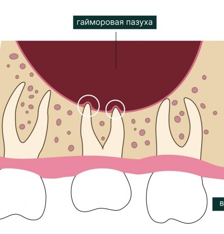 Зуб в гайморовой пазухе: симптомы и лечение