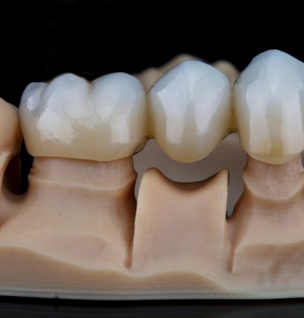 Установка зубного моста: цена, этапы, как крепится