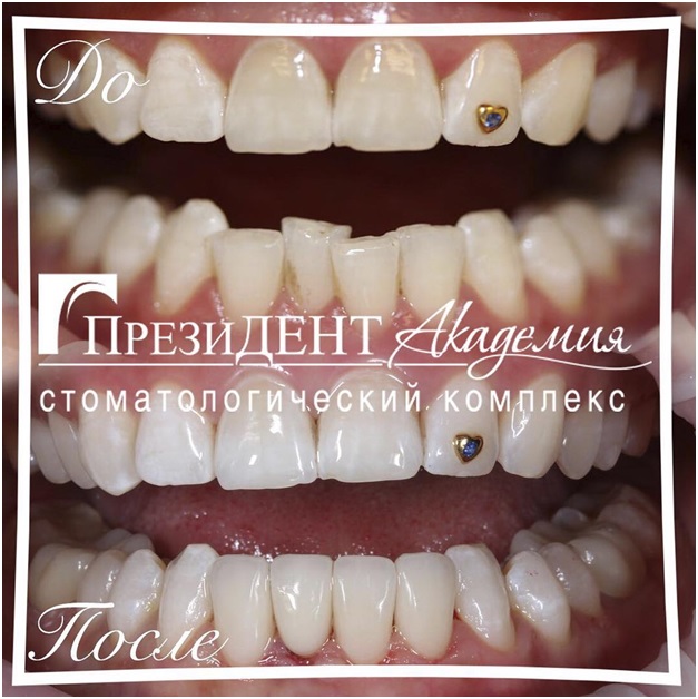 Восстановление передних зубов нижней челюсти керамическими винирами «Emax».