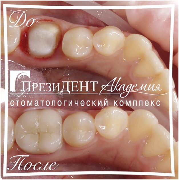 Проведено ортопедическое лечение - восстановление части зуба под коронкой.