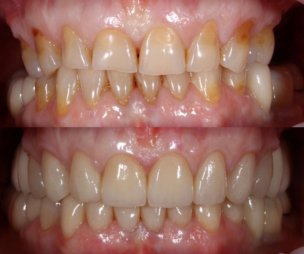 Тотальное поэтапное протезирование винирами E-max в области зоны улыбки и коронками безметаловыми из диоксида циркония с опорами на имплантаты в области жевательных зубов.
