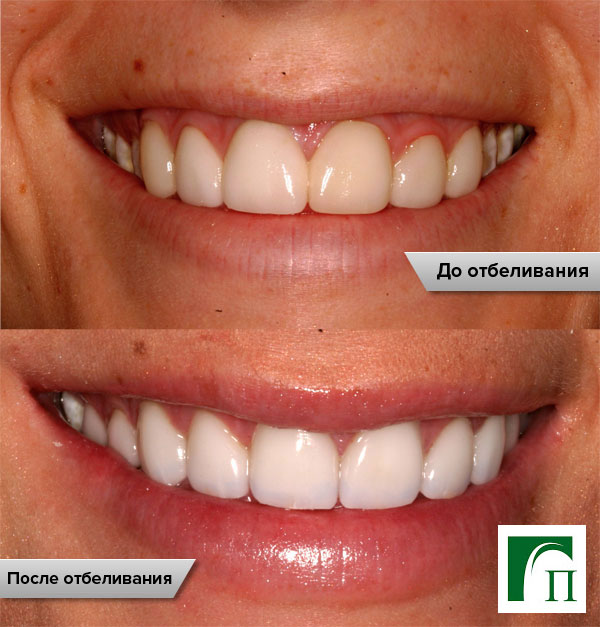 Отбеливание зубов химически Отбеливание зубов химически щетка oral b pro