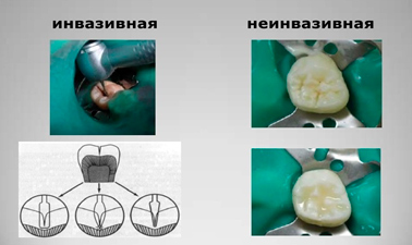 Герметизация фиссур инвазивная и неинвазивная Реставрация зубов Томск Светлый
