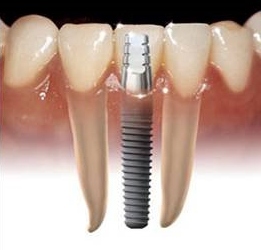 имплантация зубов