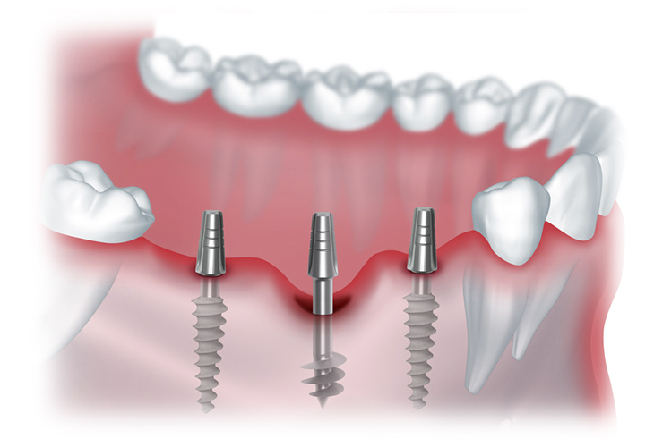 Имплантация зубов без боли – стоматология Президент