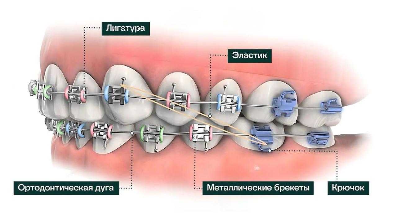 брекет-система на зубы как выглядят