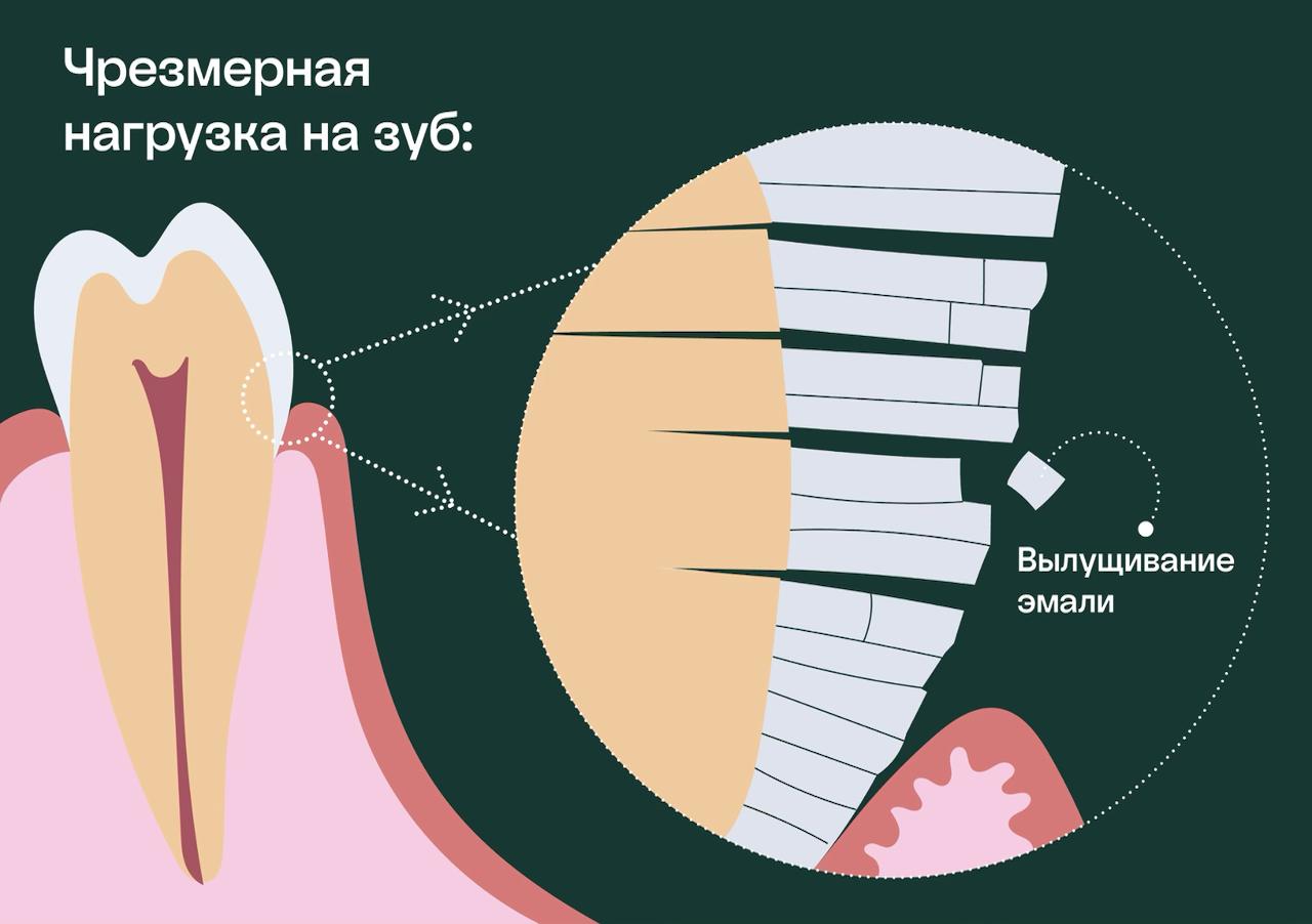 чрезмерная нагрузка на зуб