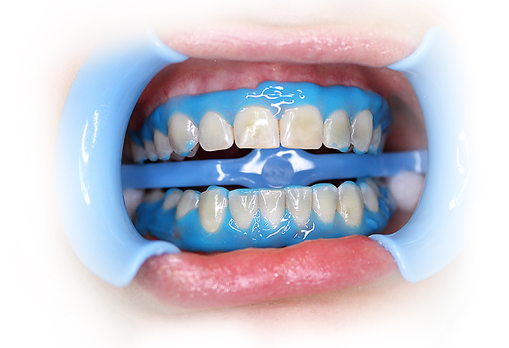 Химическое отбеливание зуб киров ирригатор