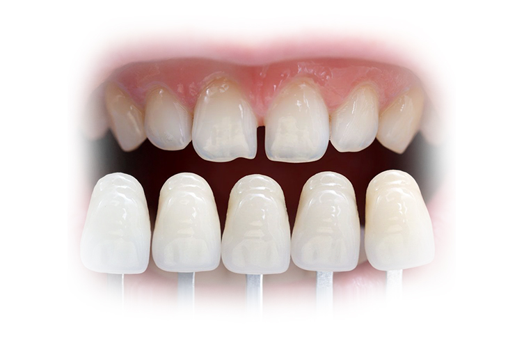 исправление прикуса винирами