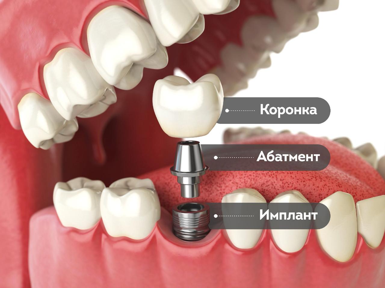 как выглядит дентальная имплантация зуба