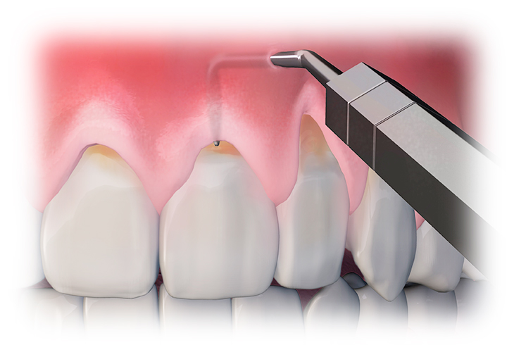 Лечение рецессии десны по доступным ценам в стоматологии «ПрезиДент»