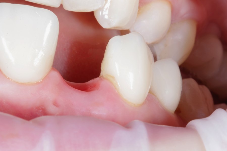 Сухая лунка после удаления зуба - симптомы и как лечить