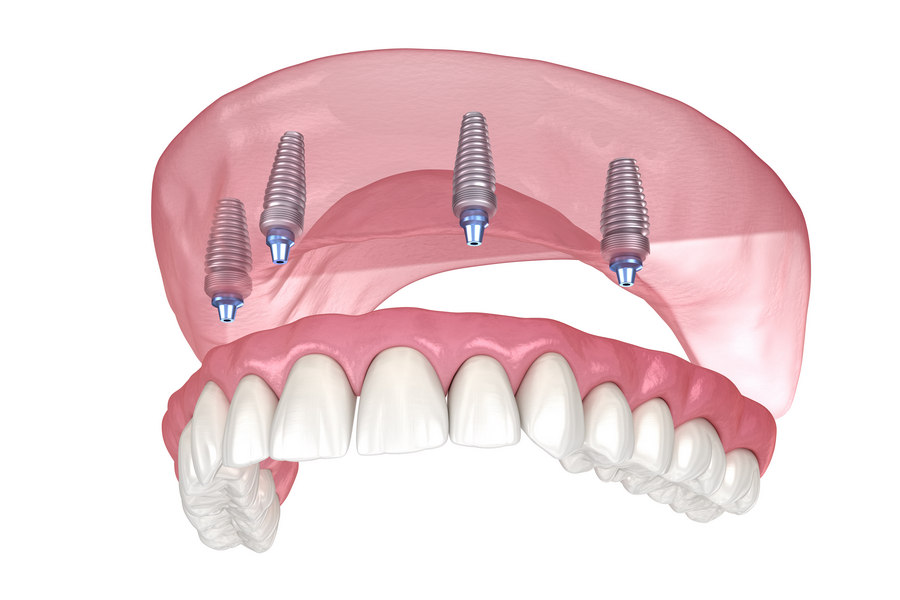 Новые технологии имплантации зубов