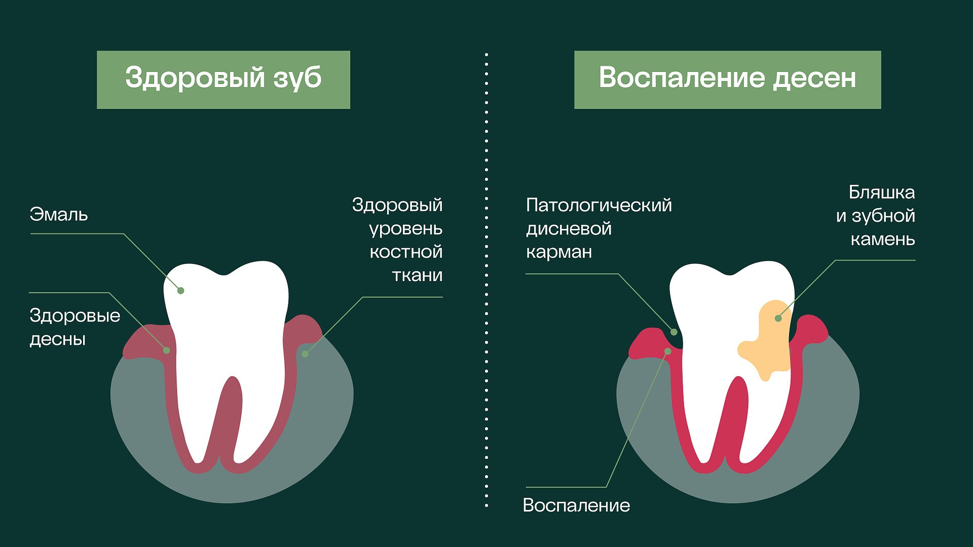 отличие здорового и воспаленного зуба