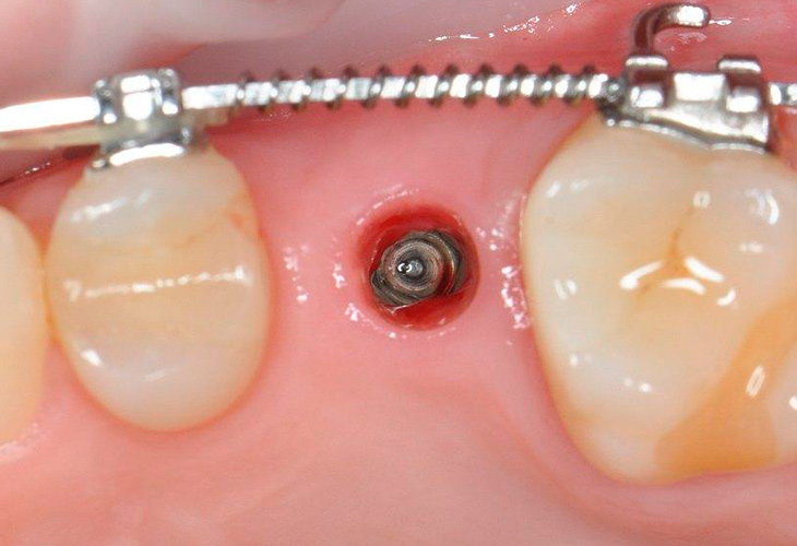 что такое синус-лифтинг что такое синус-лифтинг