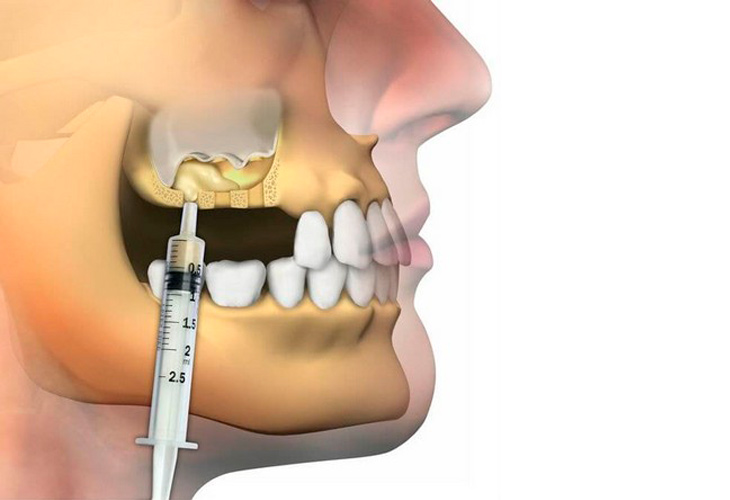 операция синус-лифтинг операция синус-лифтинг