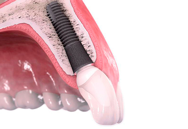 проведение синус-лифтинга зубов проведение синус-лифтинга зубов