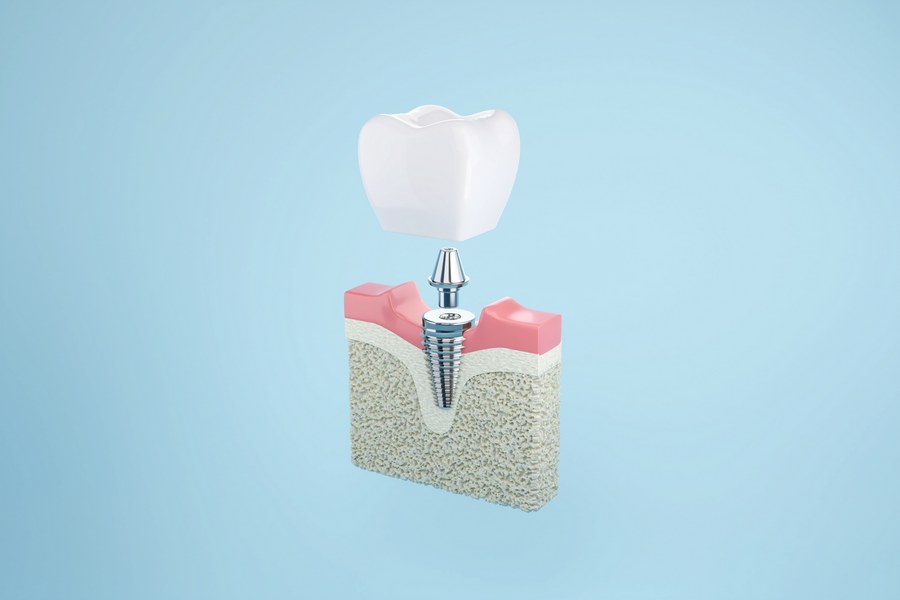 Стоматологическая имплантация зубов