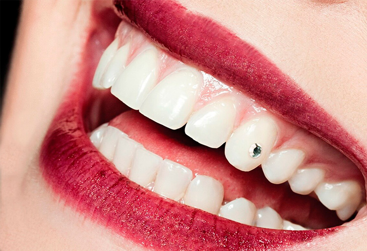 Стразы на зубах Томск Приречная томск стоматология улыбка цены