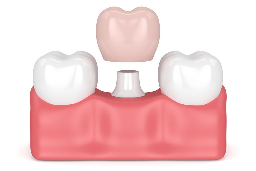 Виды коронок на импланты