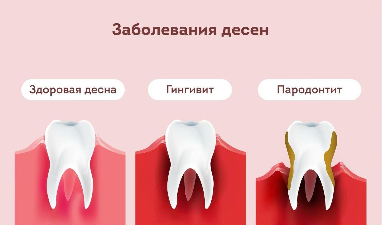 виды заболевания десен