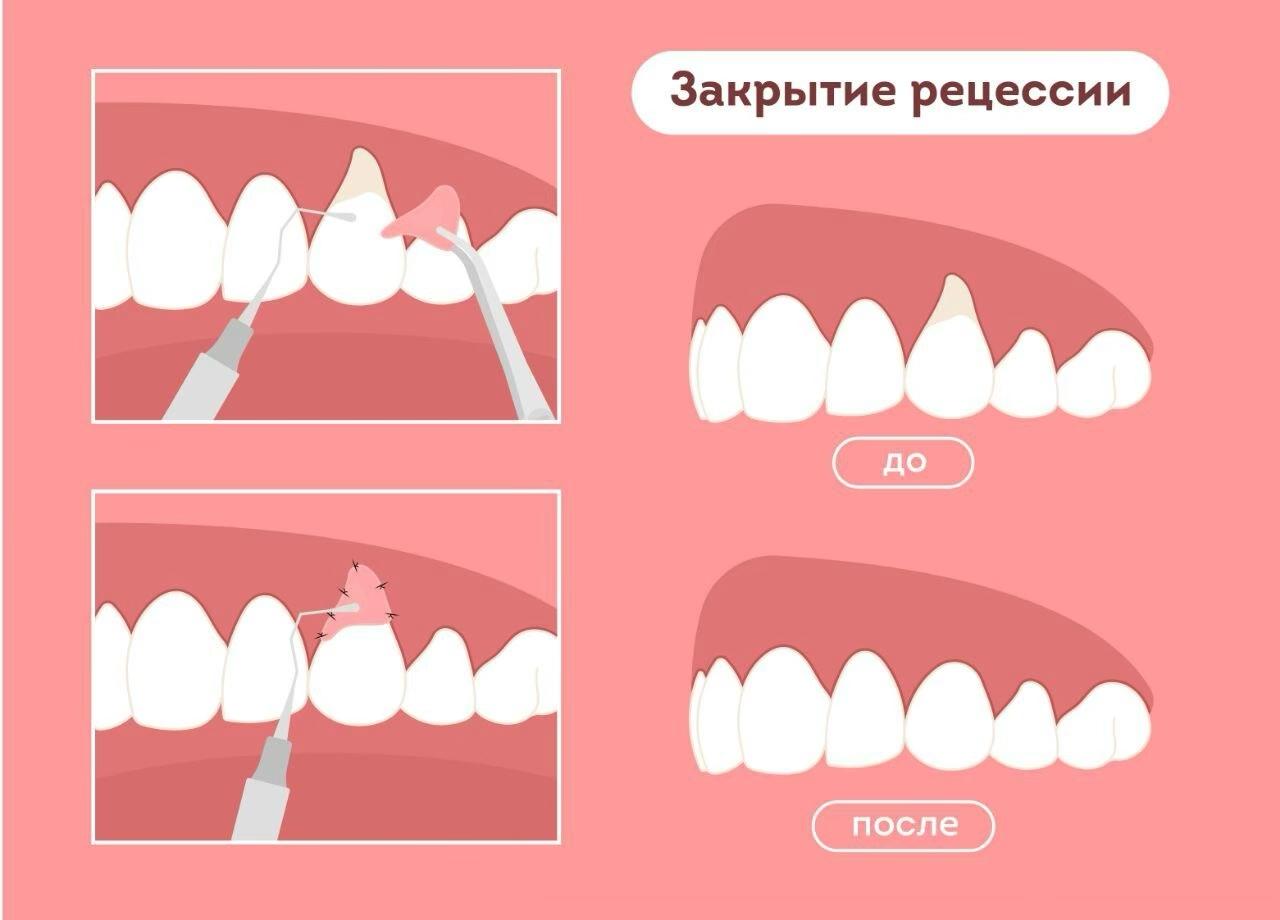 закрытие рецессии десен